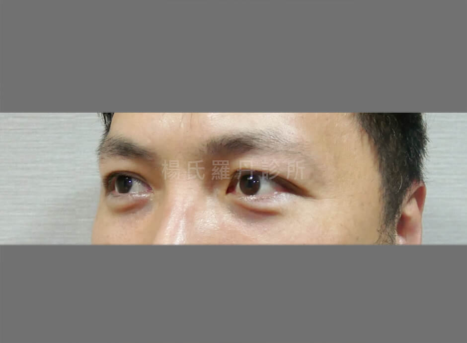 眼袋 眼袋手術 眼袋消除