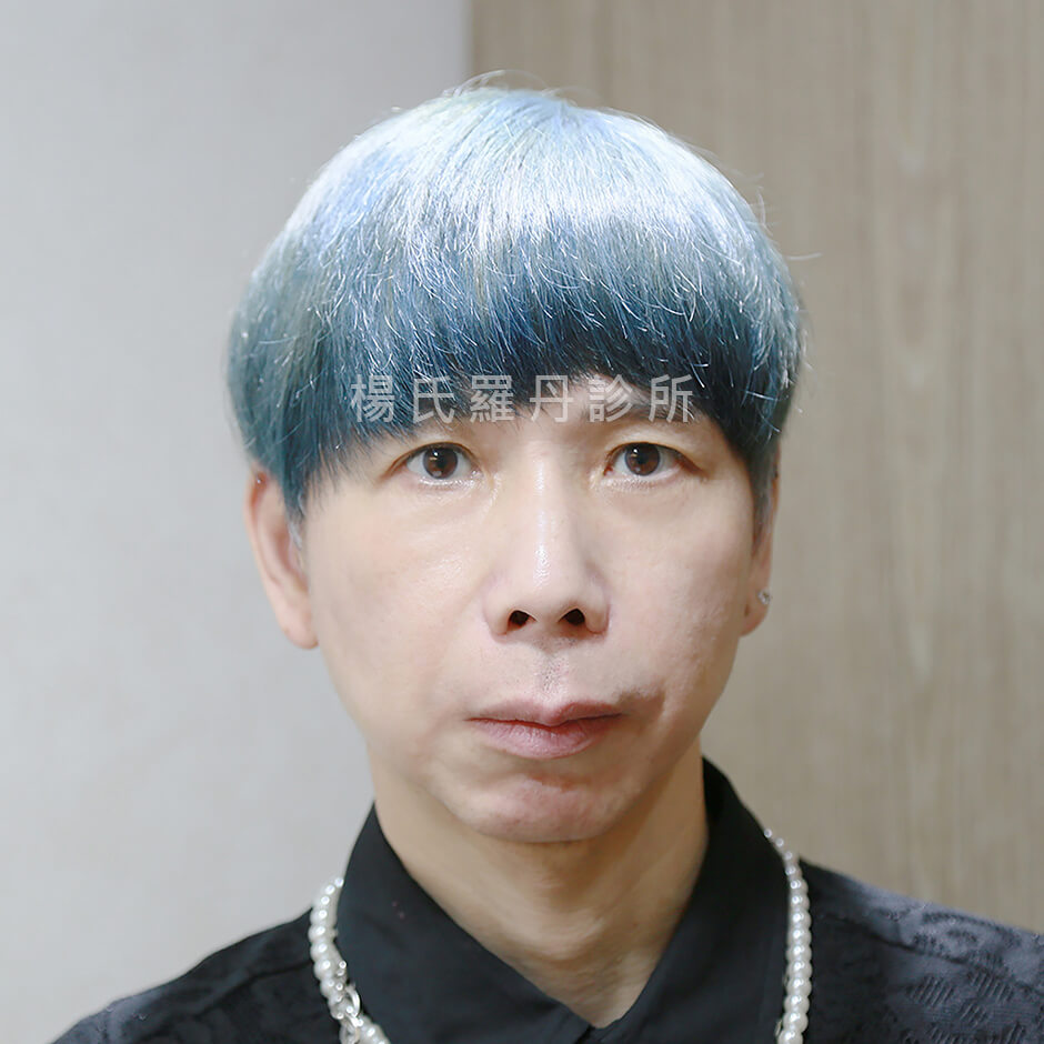 鼻雕 縮鼻翼 挺鼻 醫學美容