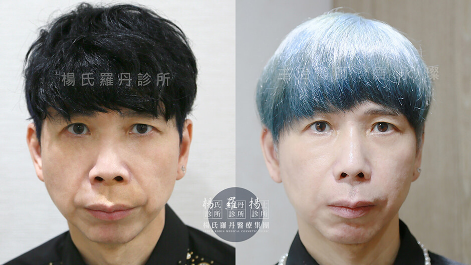 鼻雕 鼻型調整 挺鼻 陳其偉