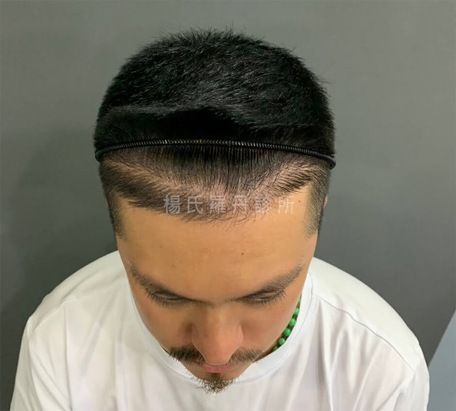 植髮 黃遠 植鬍 生髮613