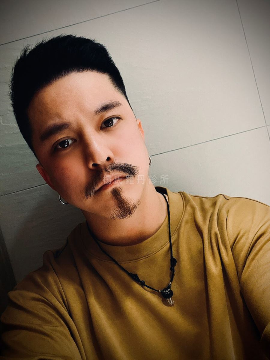 黃遠 植髮 植鬍 植髮手術