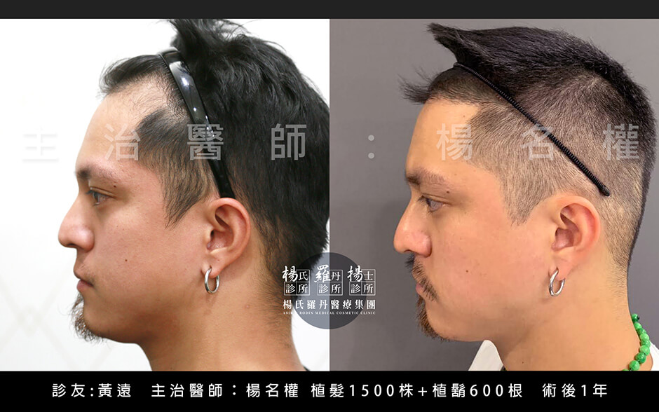 植髮 植髮手術 黃遠 生髮613