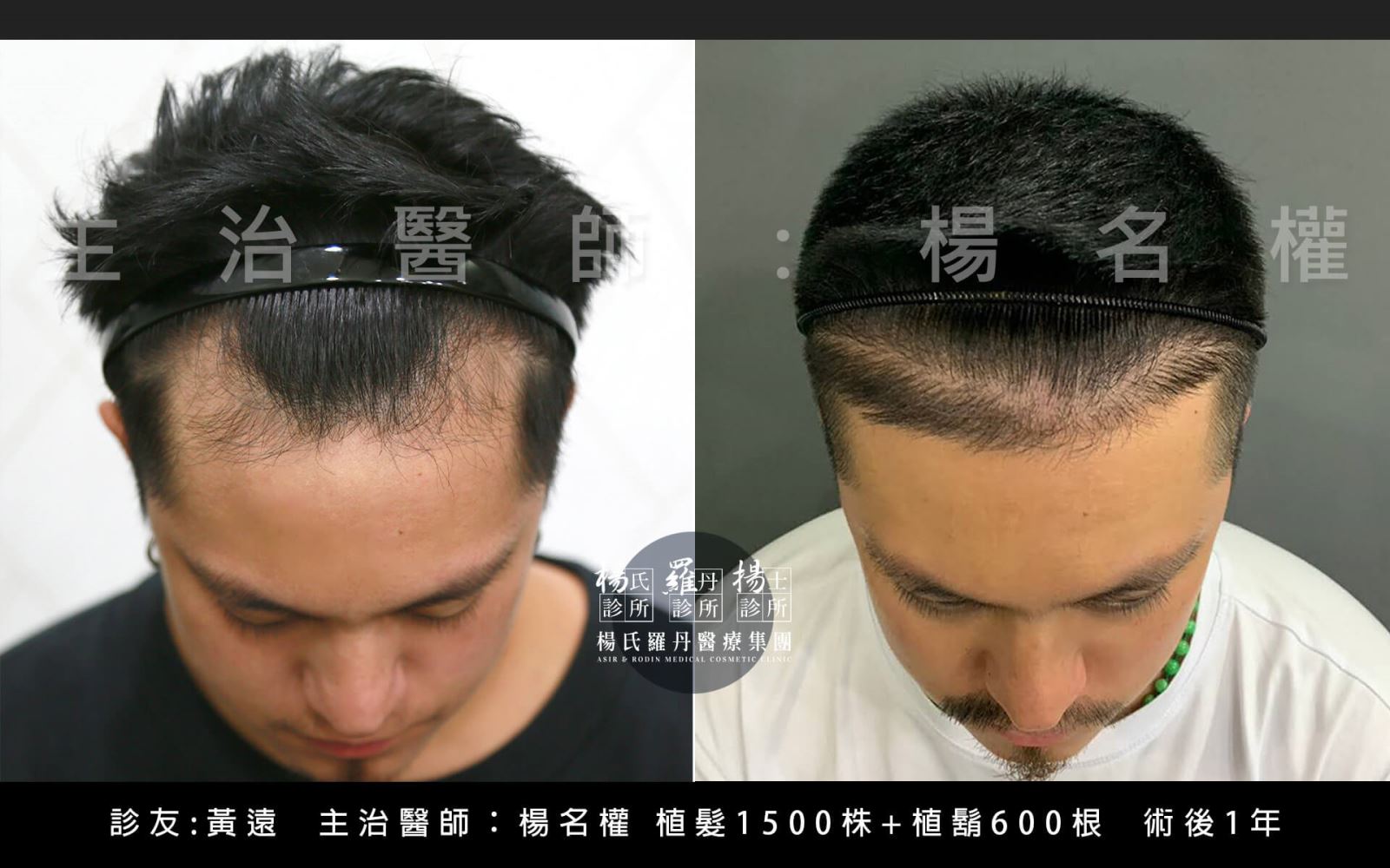 植髮 美型植髮 植鬍