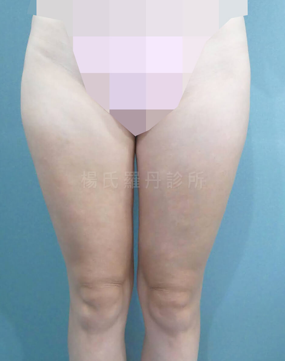 減脂 抽脂 雕塑 大腿