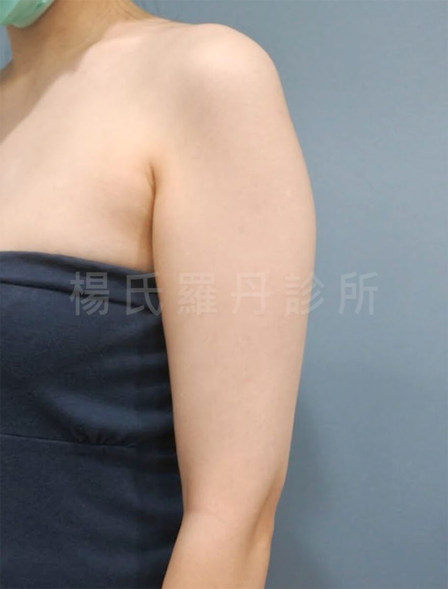 抽脂 減脂 減脂手術