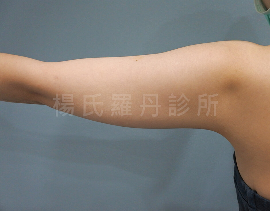 減脂 雷射減脂 蝴蝶袖