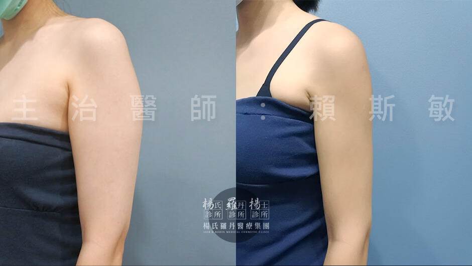 抽脂 手臂抽脂 瘦手臂