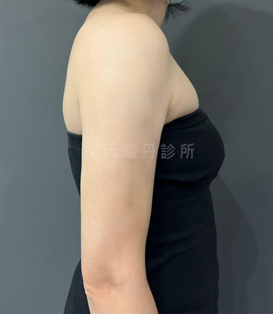 減脂 抽脂 減脂手術