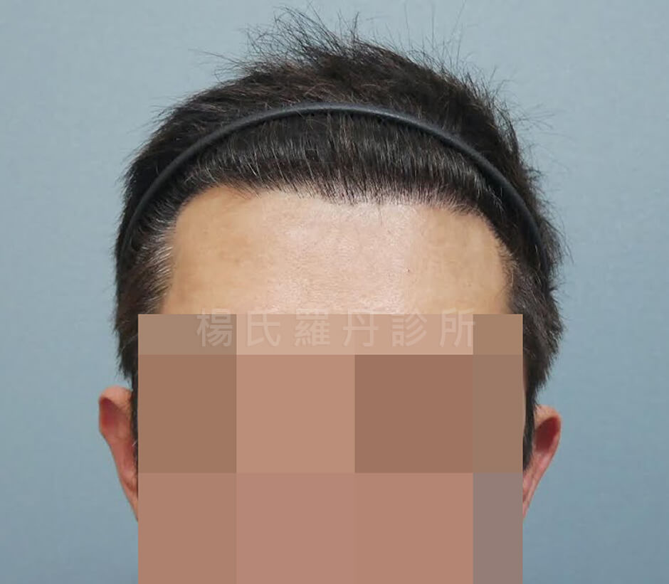 植髮 植髮手術