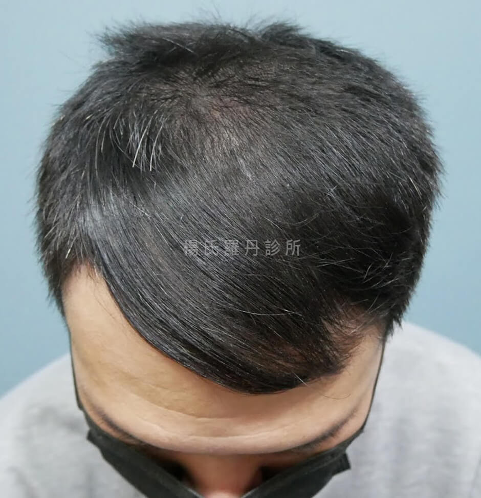 生髮 生髮613 禿頭 掉髮