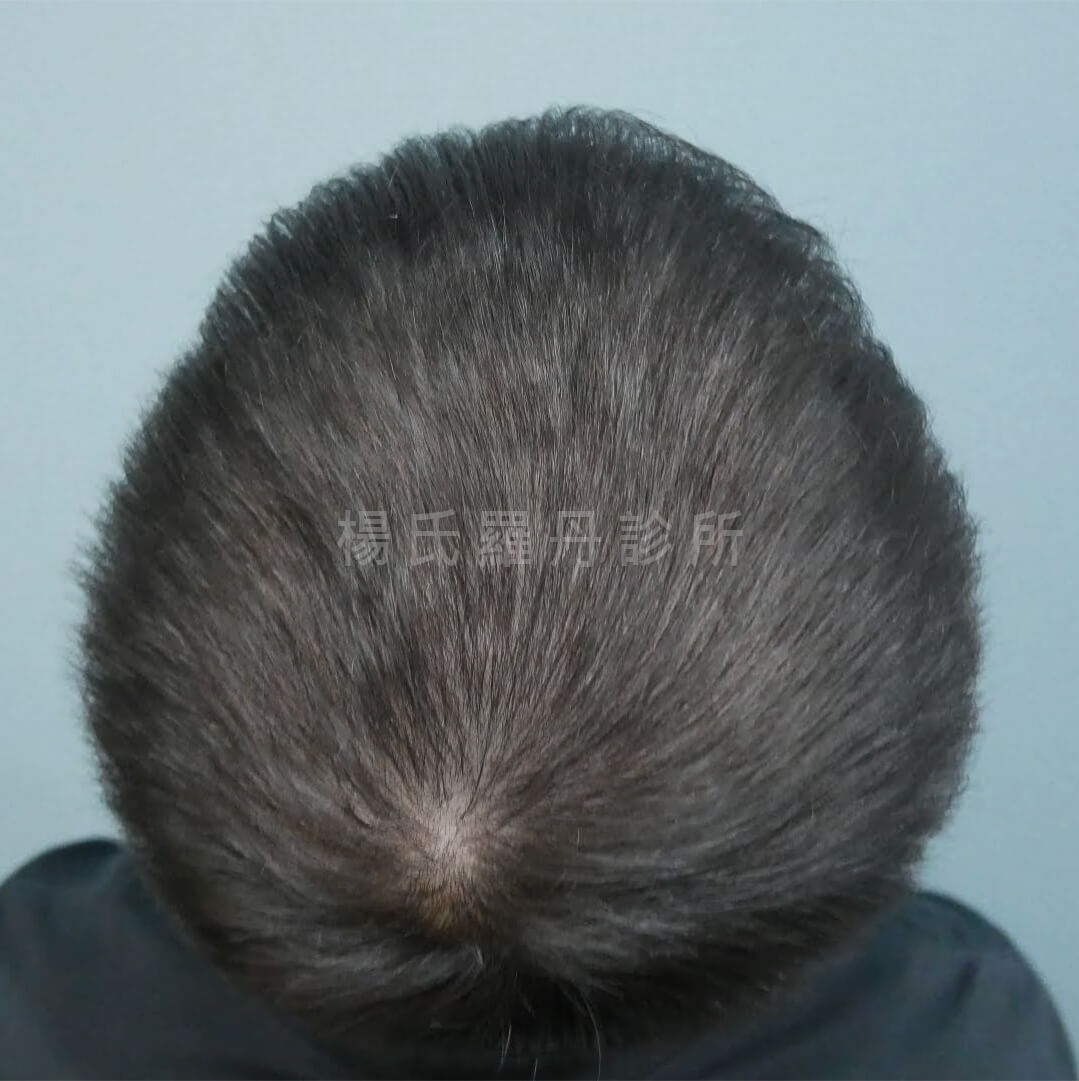 生髮 禿頭 生髮治療 張泰山頭髮