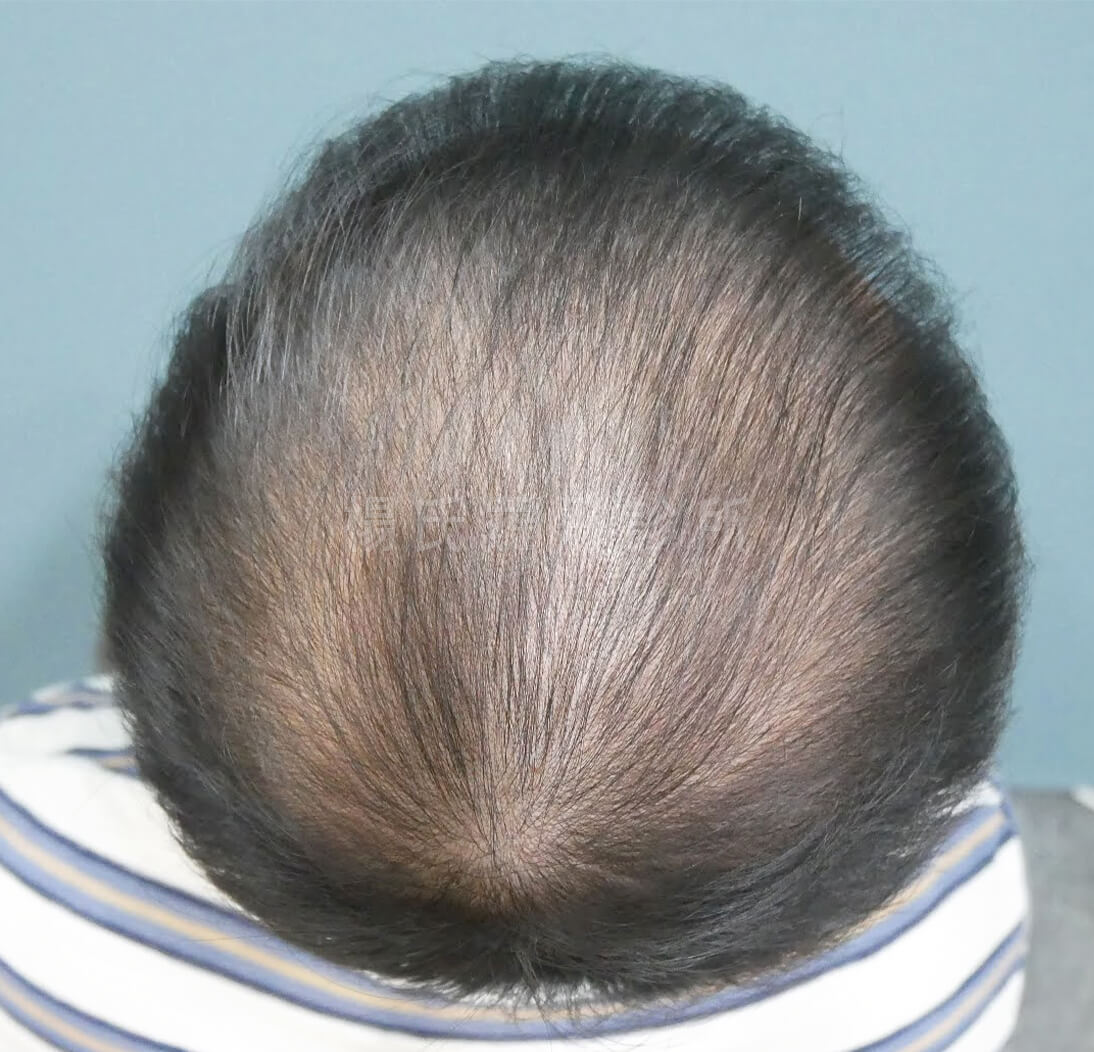 生髮 生髮治療 掉髮 張泰山生髮