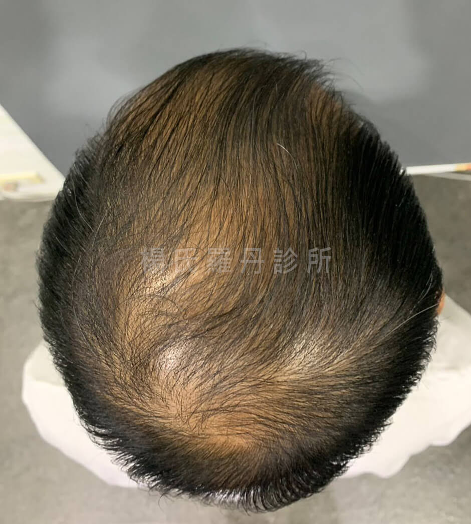 生髮 生髮療程 外泌體