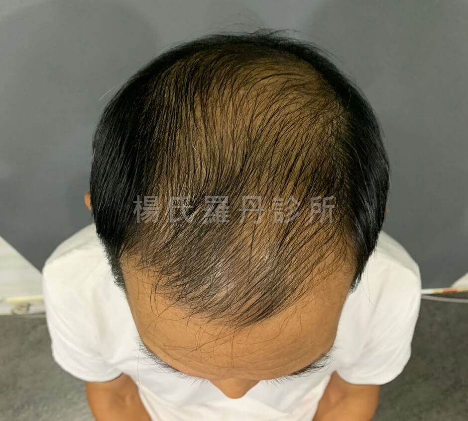 外泌體 生髮