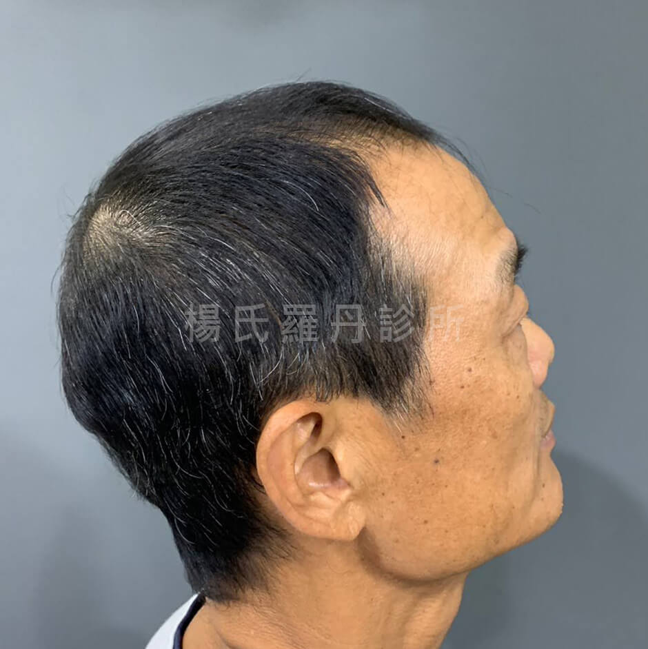 生髮 外泌體 禿髮