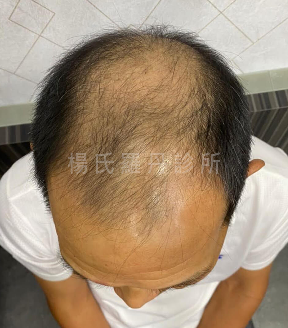 生髮 外泌體 複合式生髮