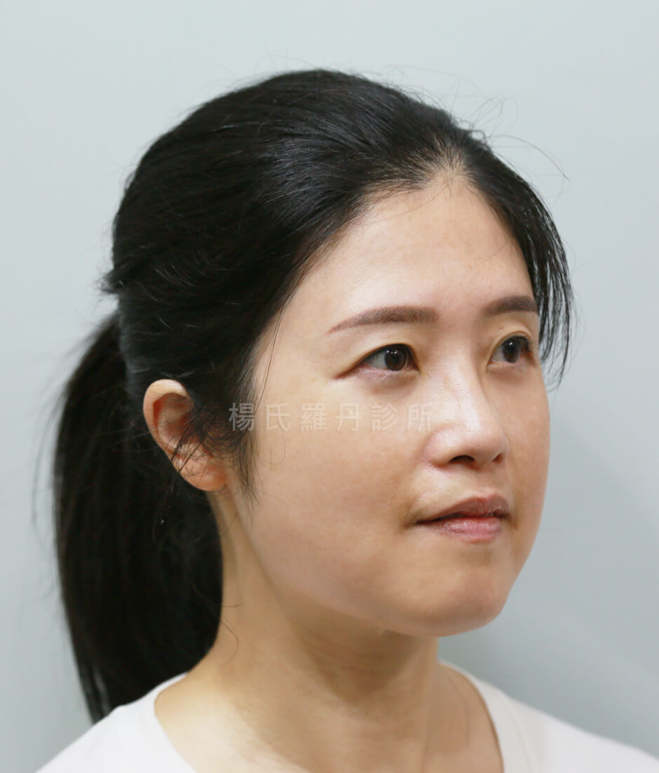 眼袋 淚溝 眼袋消除