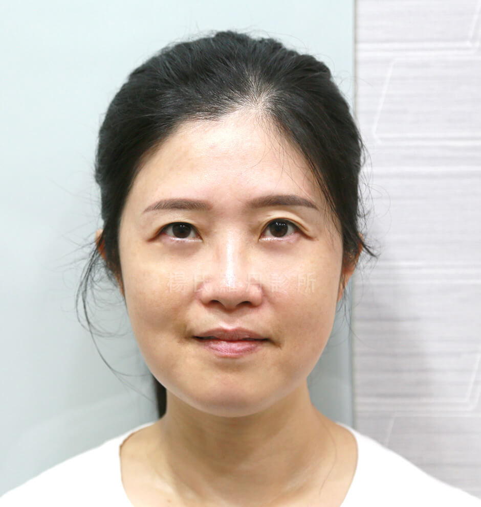 眼袋 眼袋消除 眼袋手術