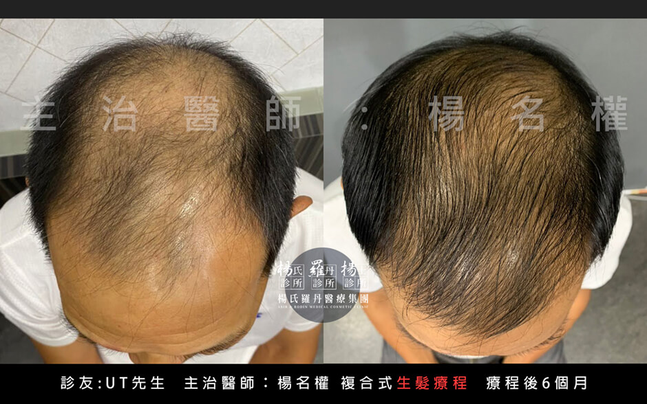 禿髮 生髮 外泌體