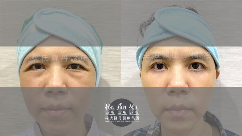 眼袋 眼袋消除 眼袋手術