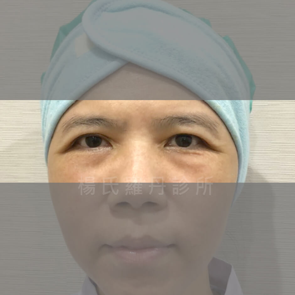 眼袋 淚溝 除眼袋