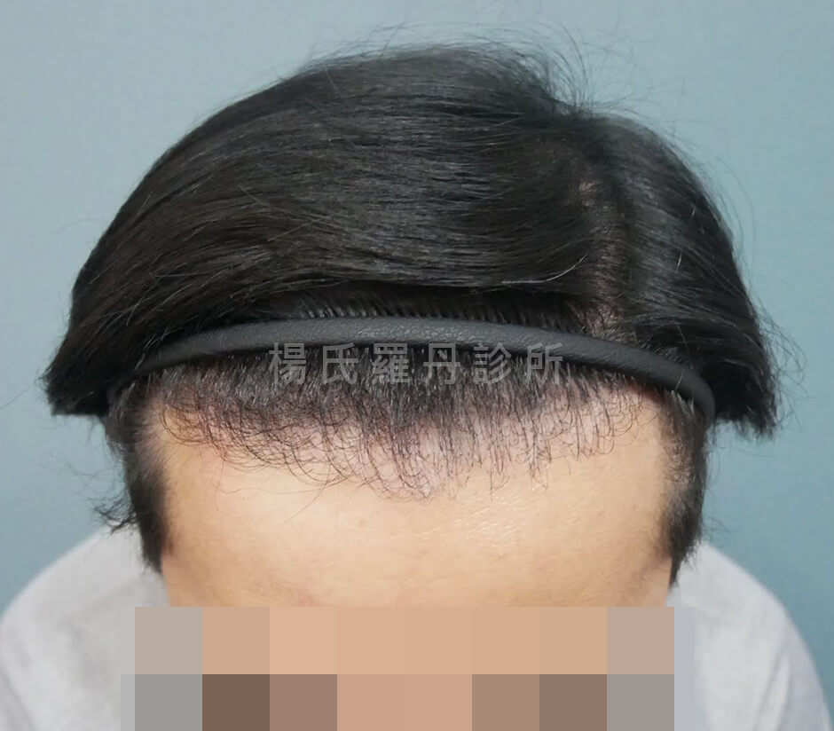 植髮 植髮手術 生髮613