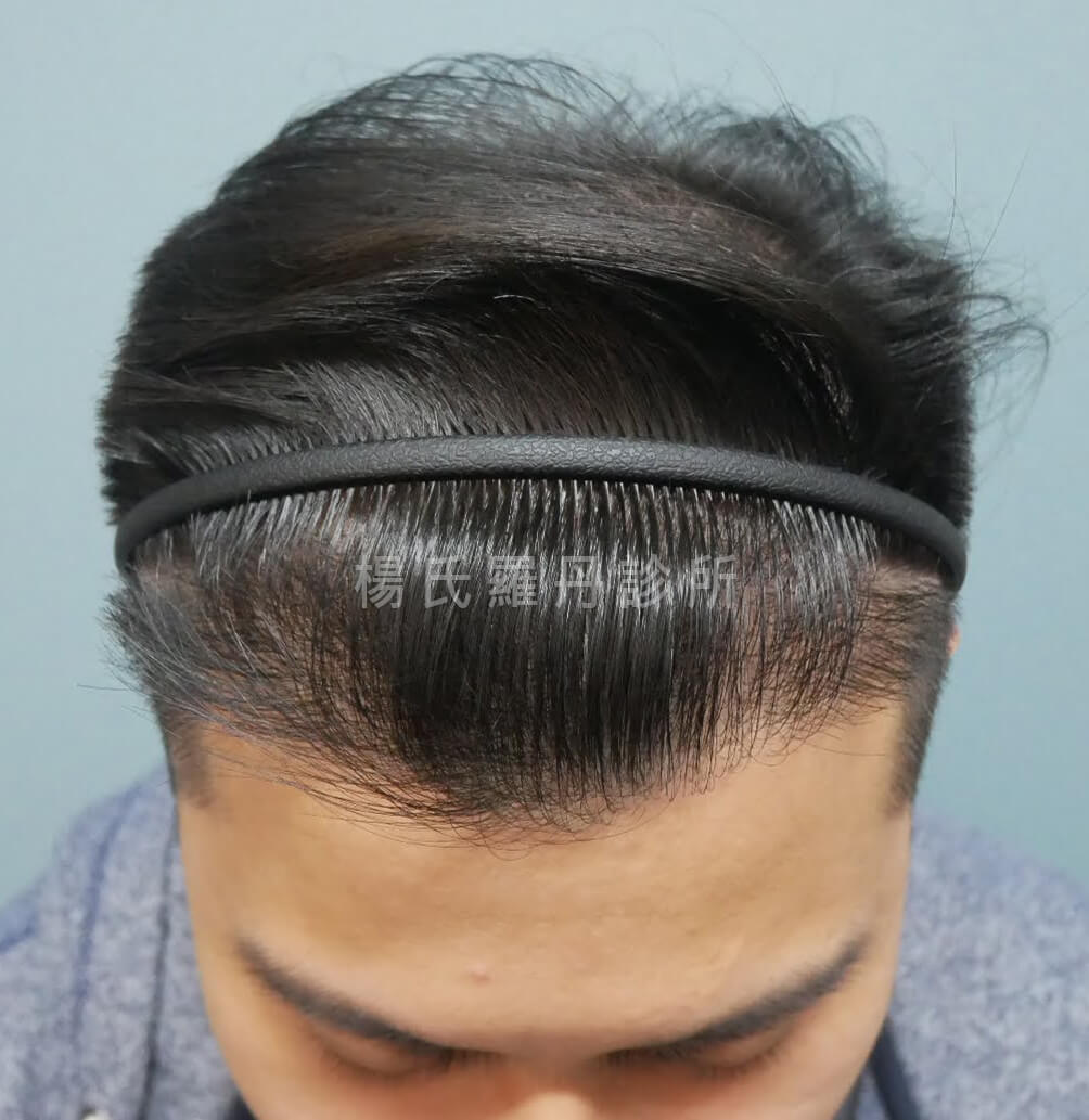 植髮 禿髮 植髮成果