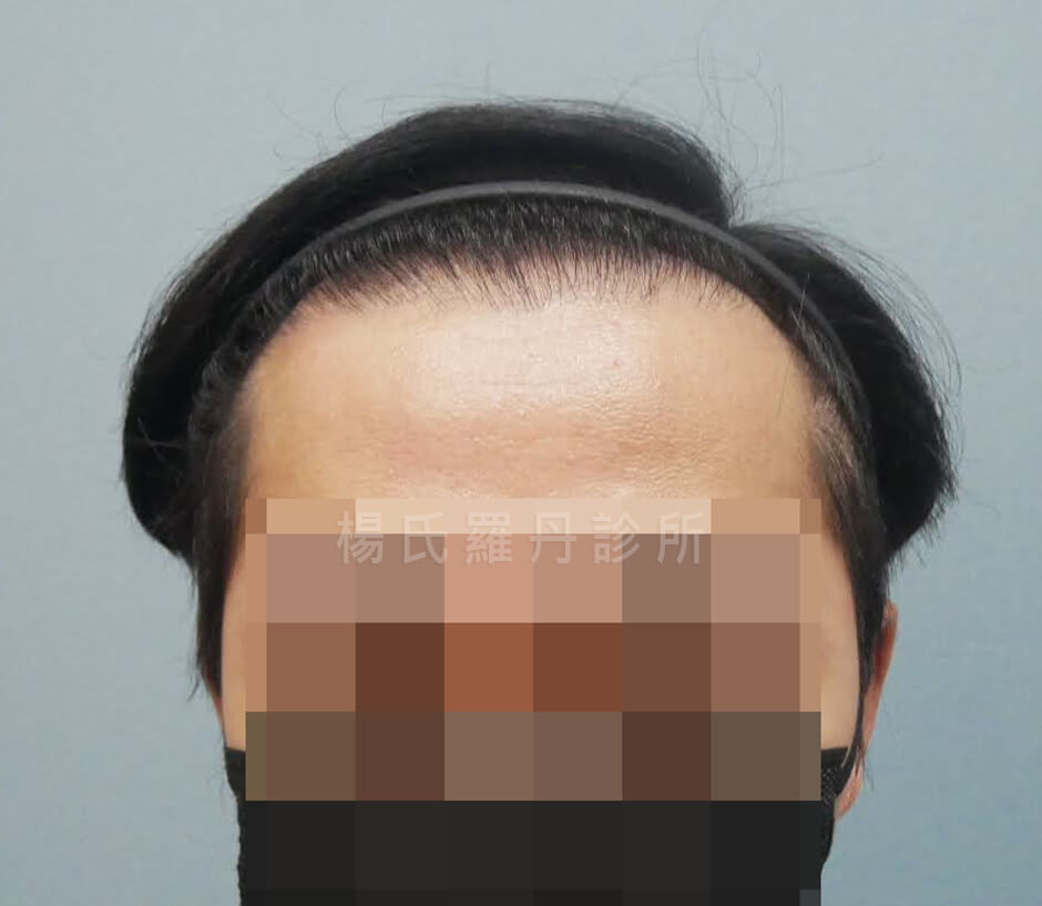 植髮 植髮成果 生髮613