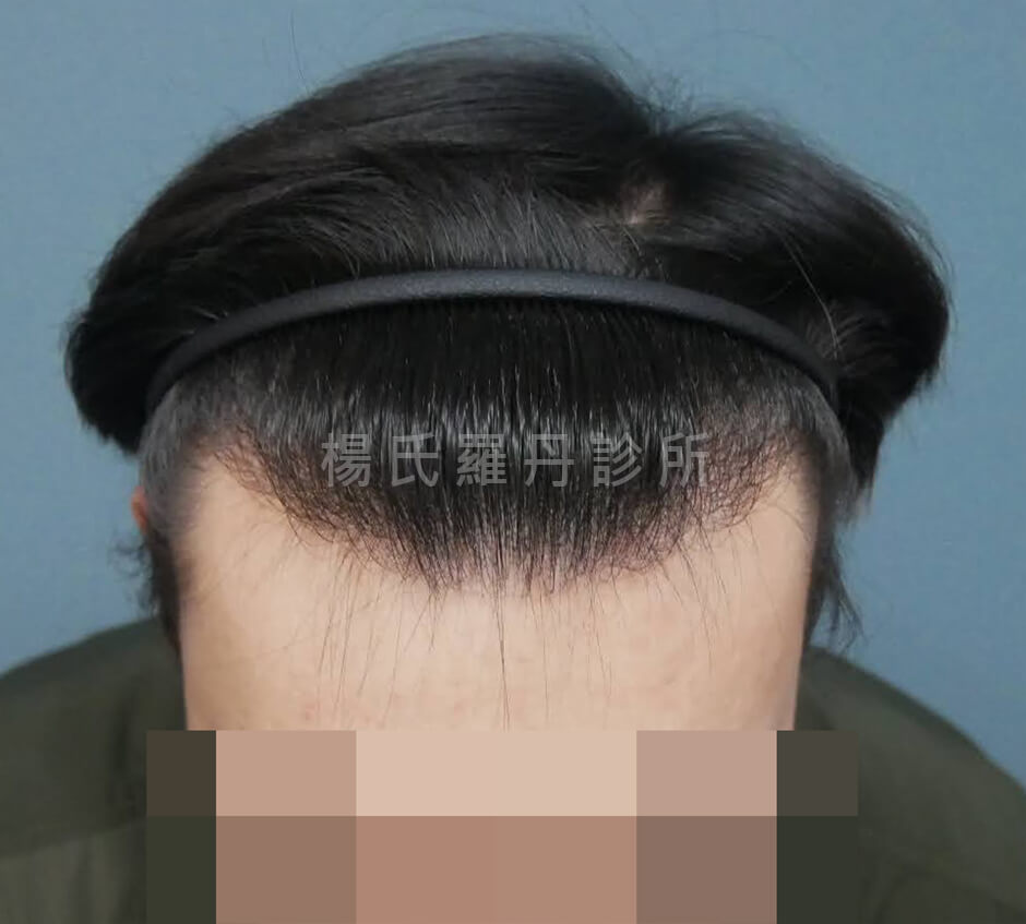 植髮 髮際線 植髮效果