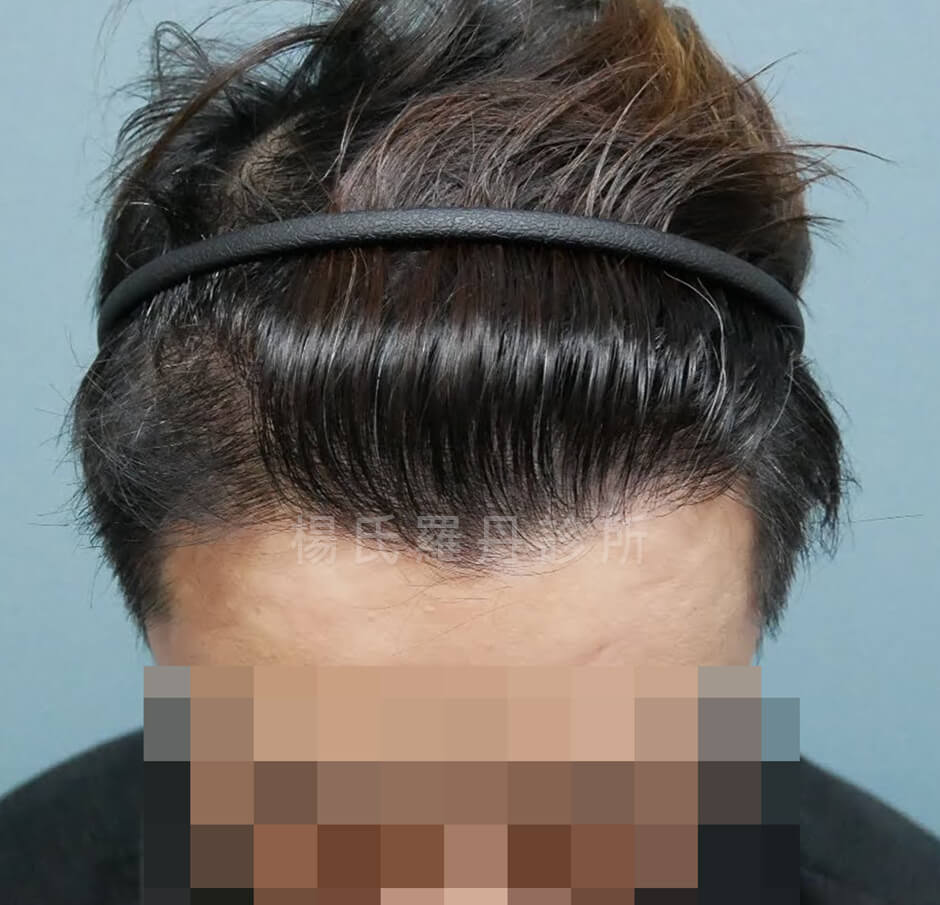 植髮 植髮手術 生髮613