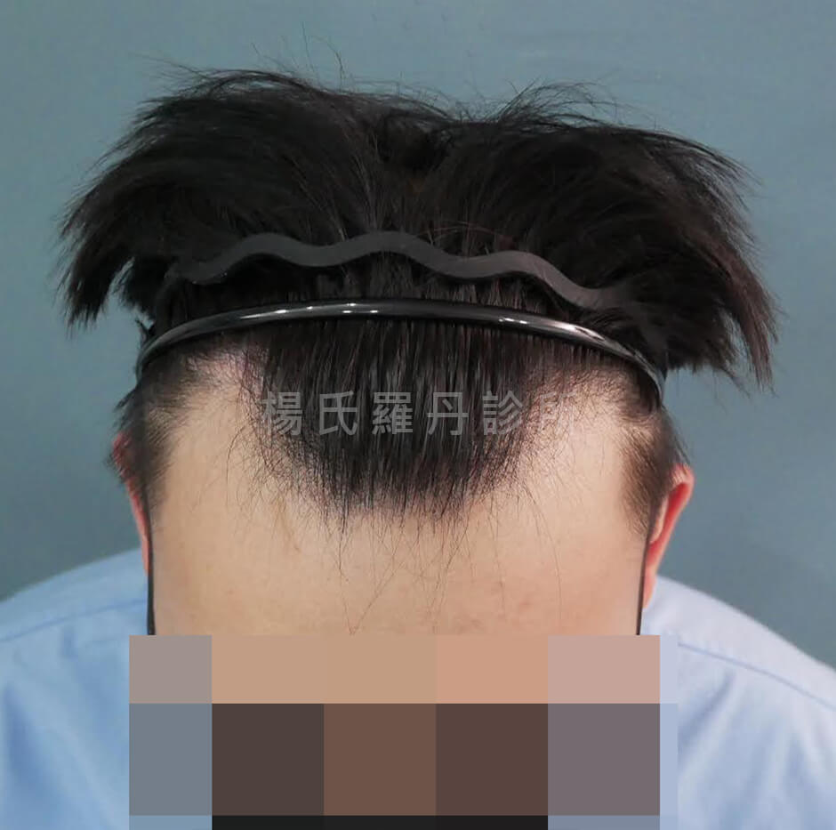 植髮 美型植髮