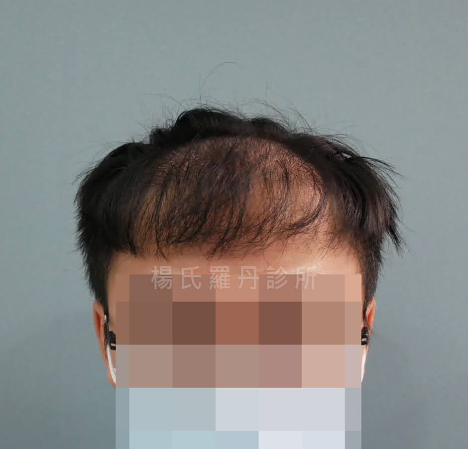 禿頭 植髮