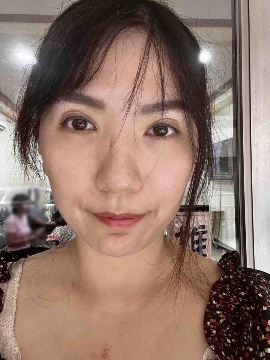 法令紋 異體真皮粉 微整