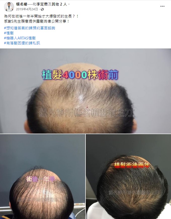植髮 落髮 植髮手術 植髮效果 禿頭
