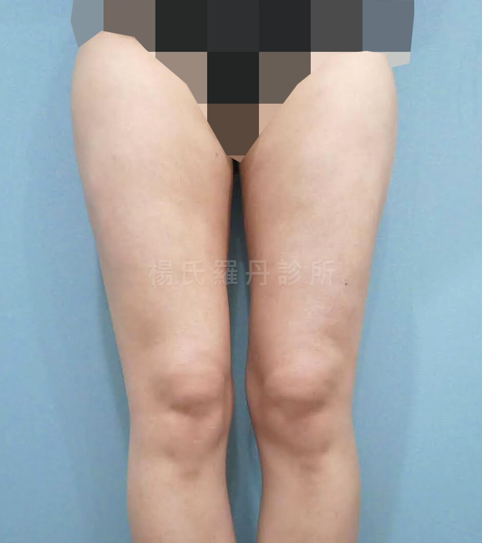 雷射減脂 抽脂 馬鞍