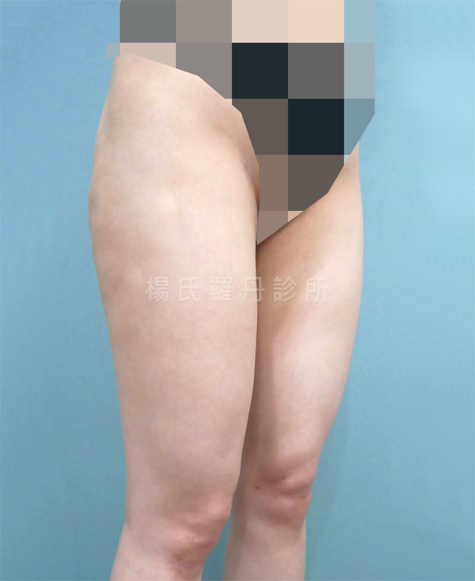 大腿抽脂 雷射減脂 抽脂