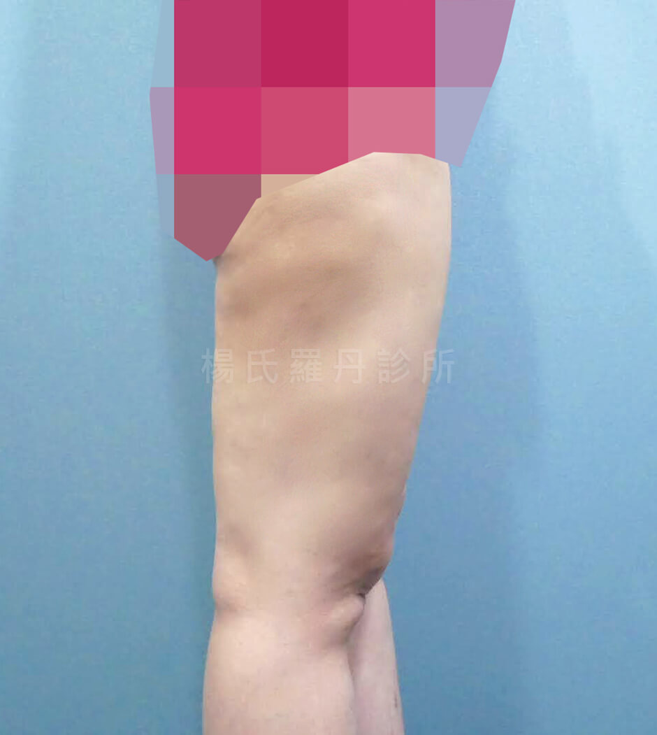 抽脂 減脂 雷射減脂