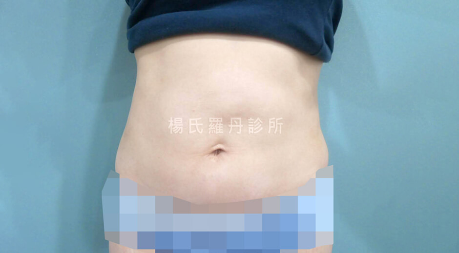 腰腹抽脂 雷射減脂 抽脂