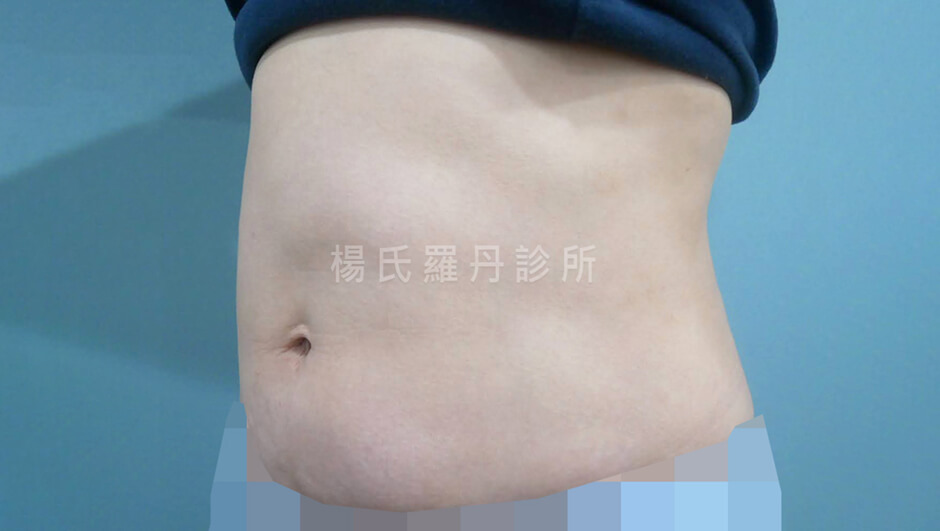 抽脂 腰腹抽脂 瘦腰