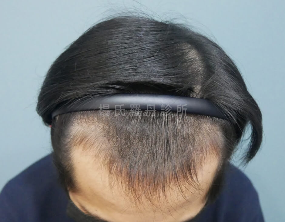 生髮療程 生髮 落髮