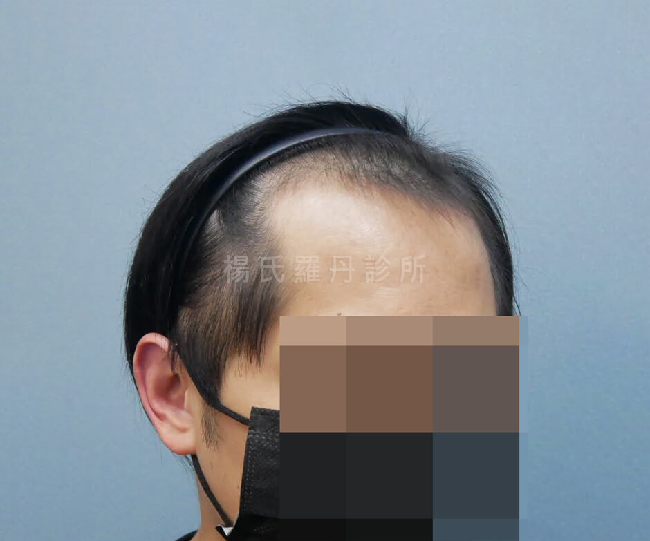 生髮 落髮 生髮成果