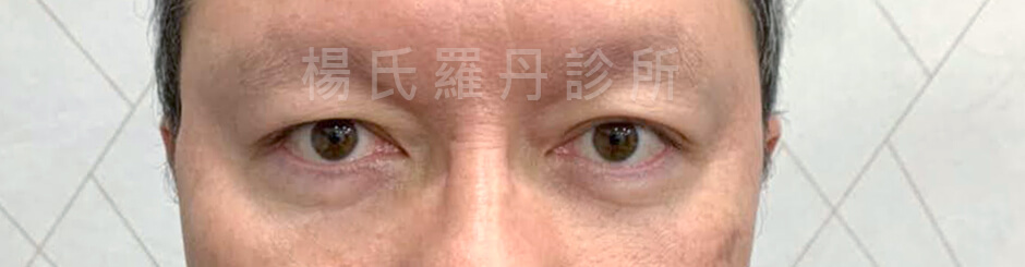 眼袋 淚溝 除眼袋