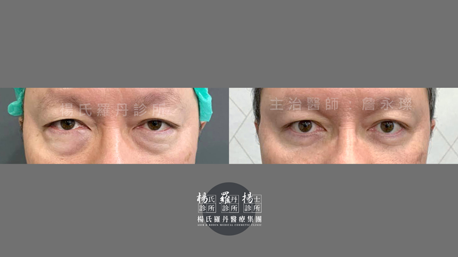 眼袋 眼袋手術 眼袋消除