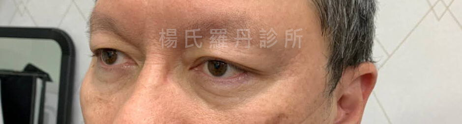 除眼袋 眼袋 眼袋手術