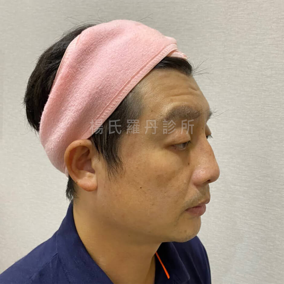 醫學美容 眼袋 鼻雕