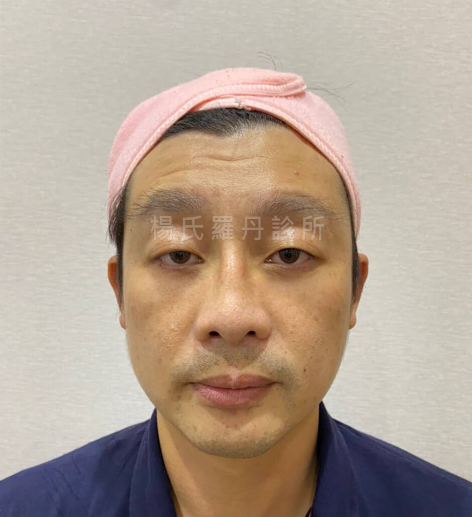 眼袋 鼻雕 鼻型調整