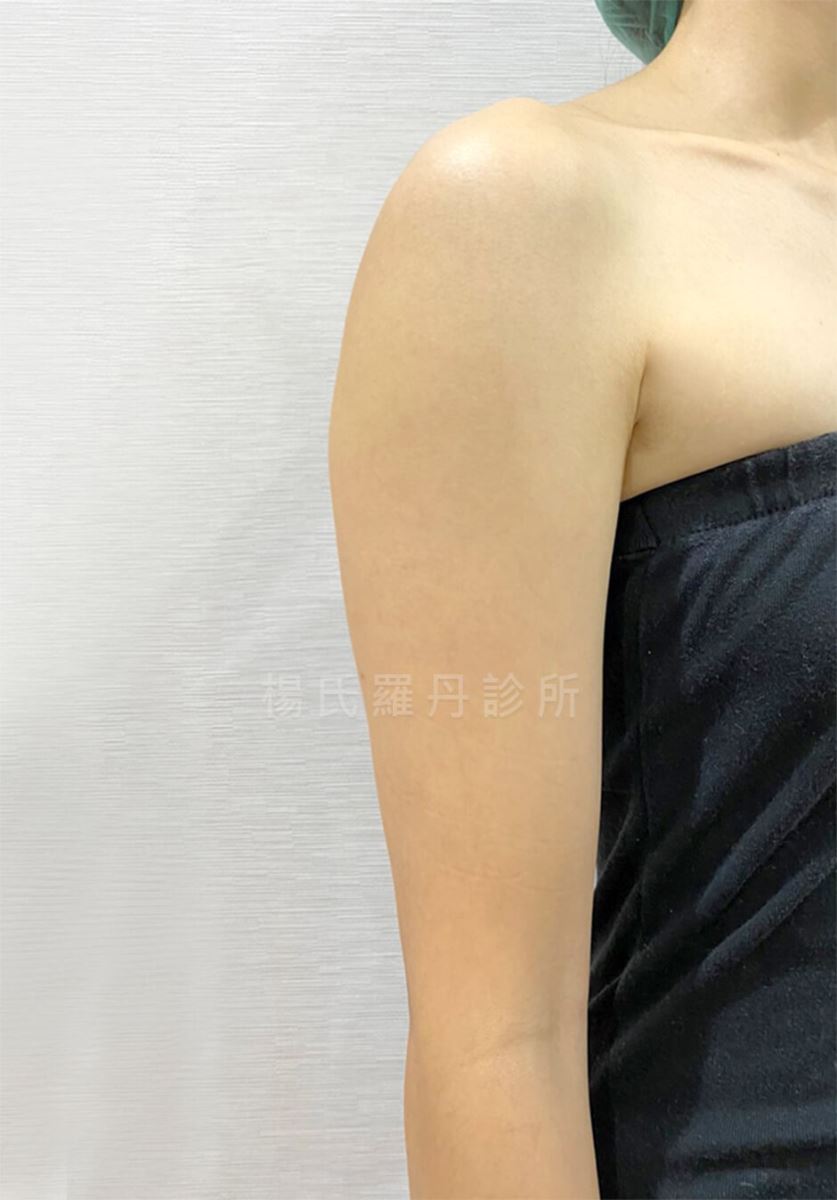 抽脂 手臂抽脂 減脂