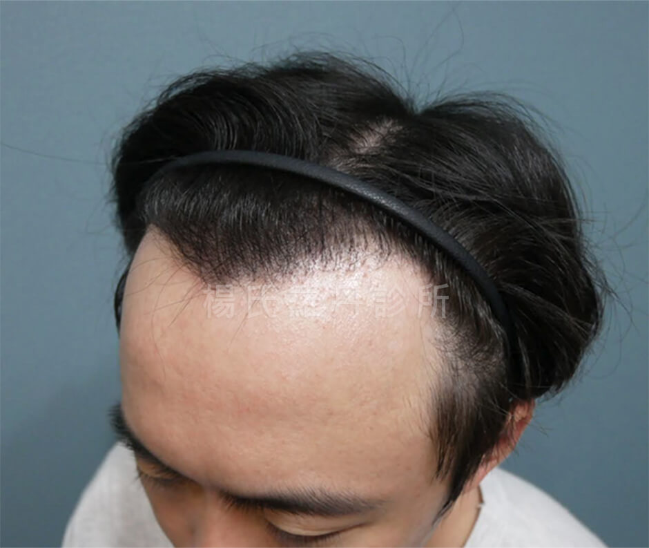 植髮手術 植髮 髮際線