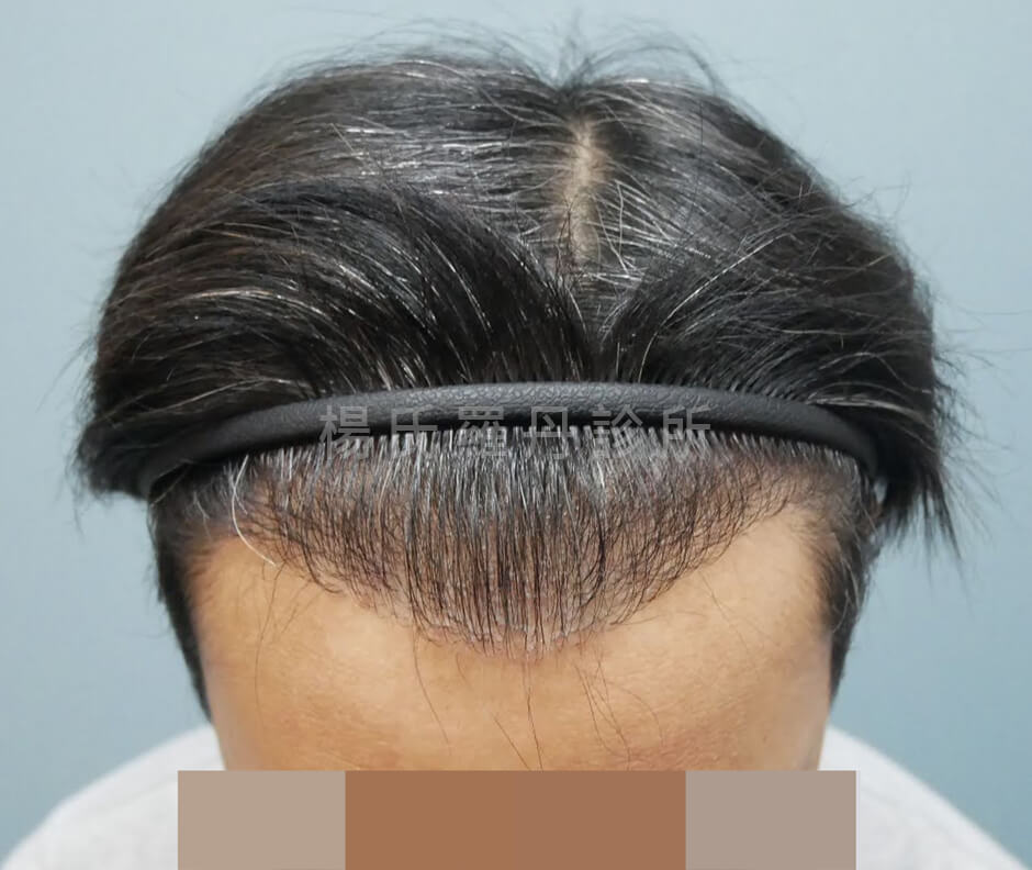 植髮 禿髮 掉髮