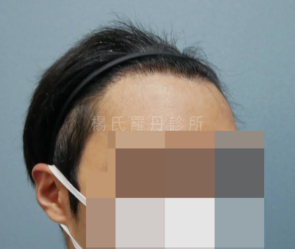 植髮手術 植髮 植髮效果